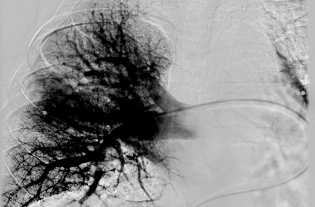 Scan demonstrating restoration of pulmonary artery blood flow post-embolectomy 